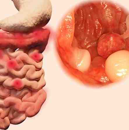 Can polyps come out in your stool?